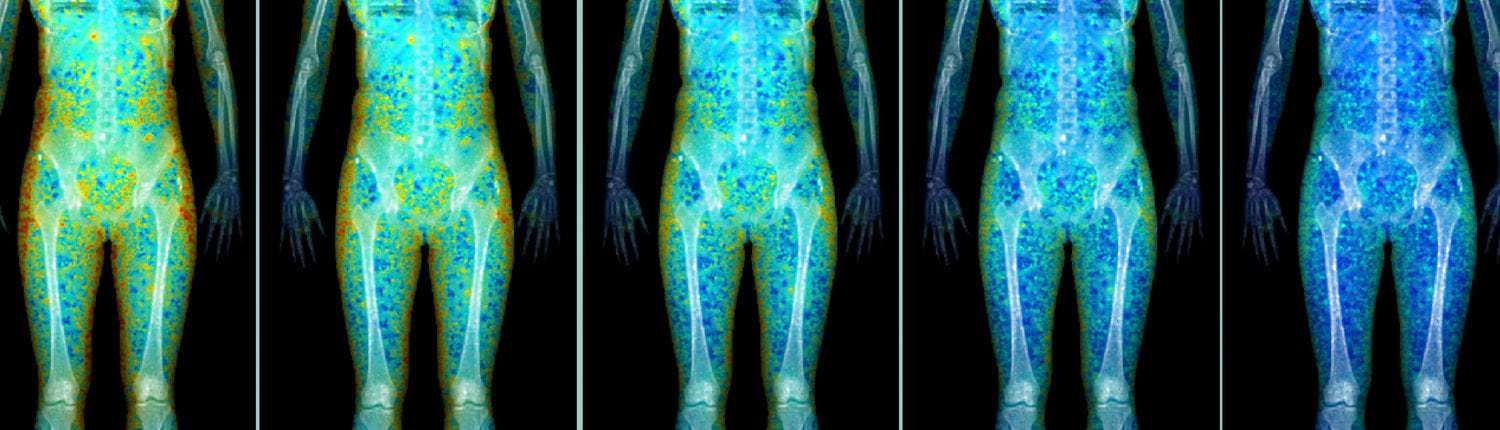 DEXA Scan